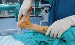 Siirt Tıpta Yeni Bir Adım Attı: Parmak Ucu Yürüme Ameliyatı Gerçekleştirildi